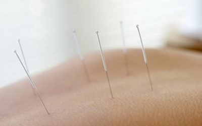 Waarom kiezen voor acupunctuur?